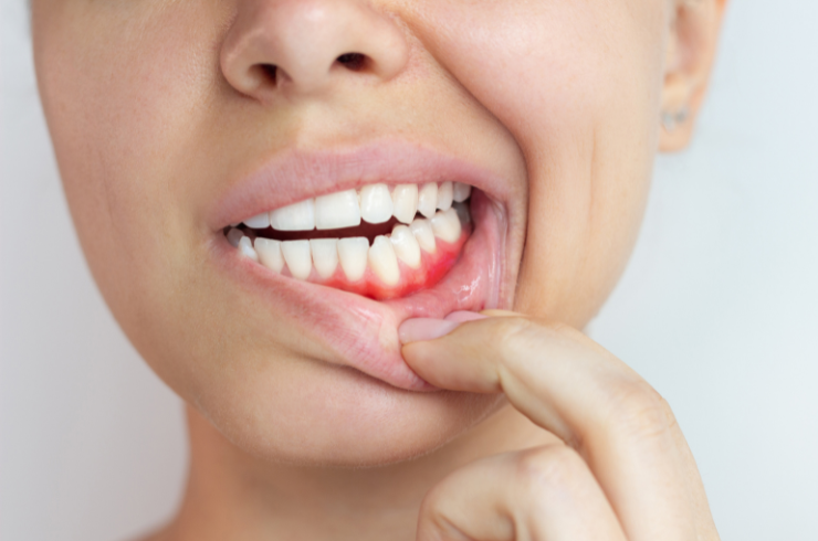 Periodontics (Gum Treatments)