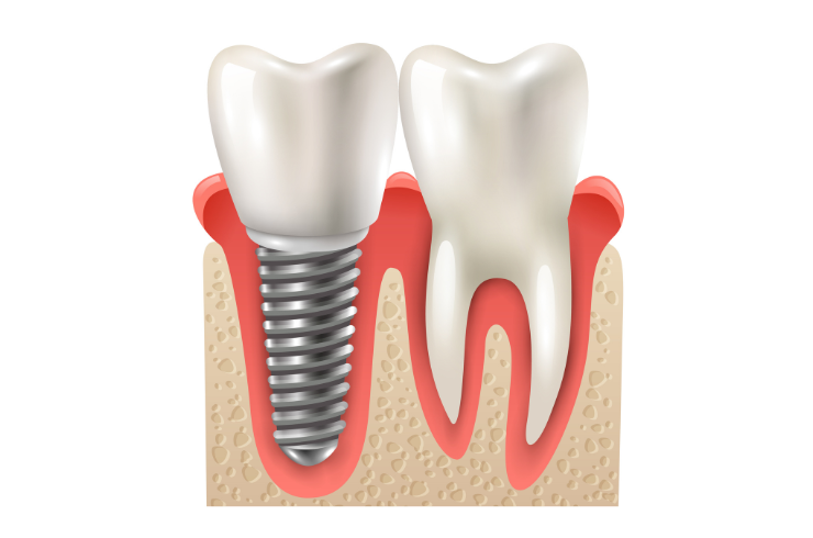 Implant Dentistry